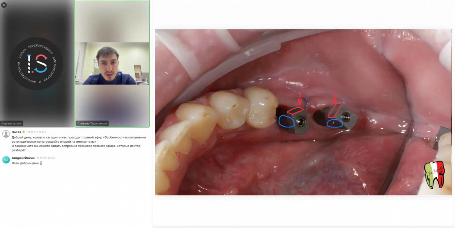 Особенности изготовления ортопедических конструкций с опорой на имплантаты