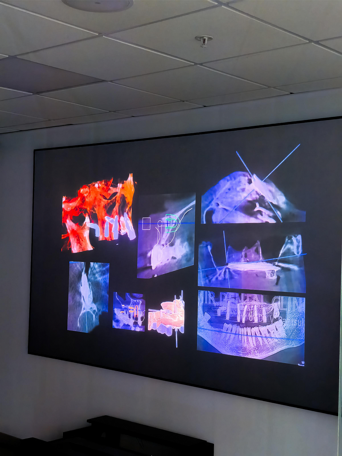 Одномоментная имплантация: от стабилизации к нагрузке