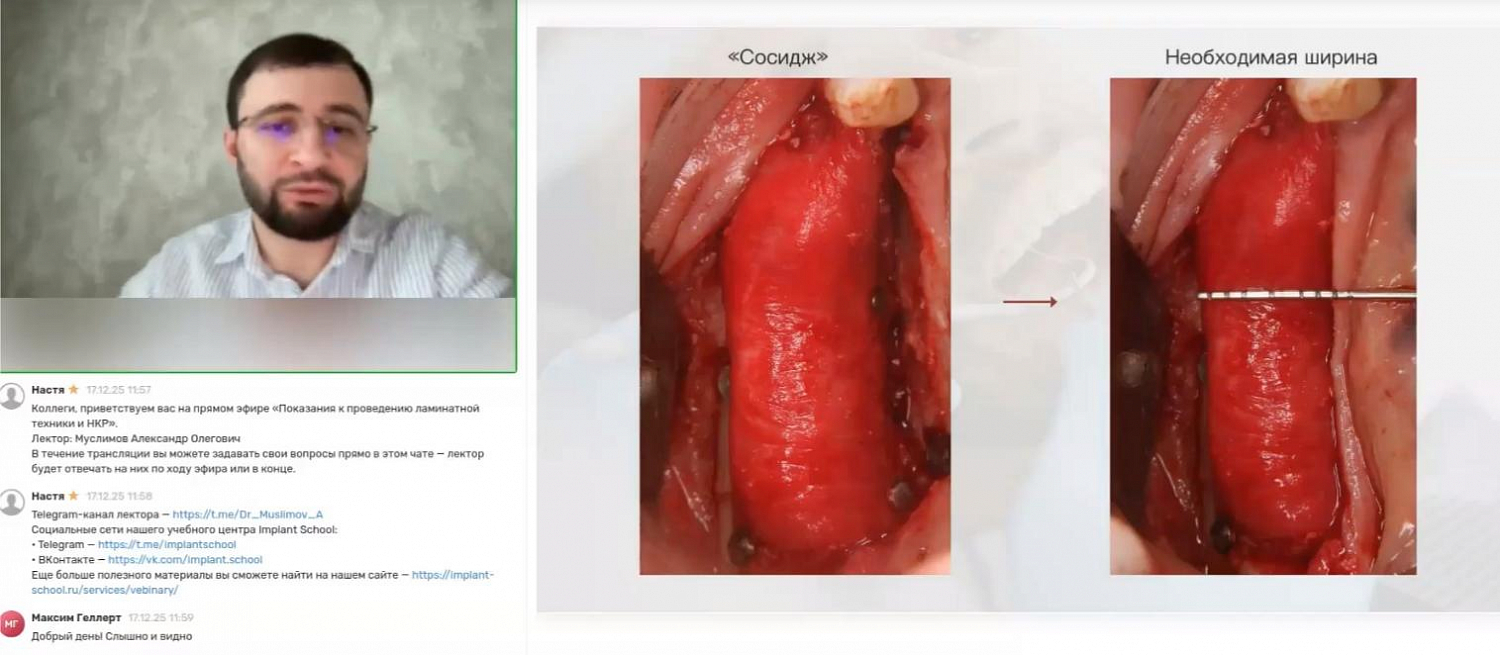 Показания к проведению ламинатной техники и НКР