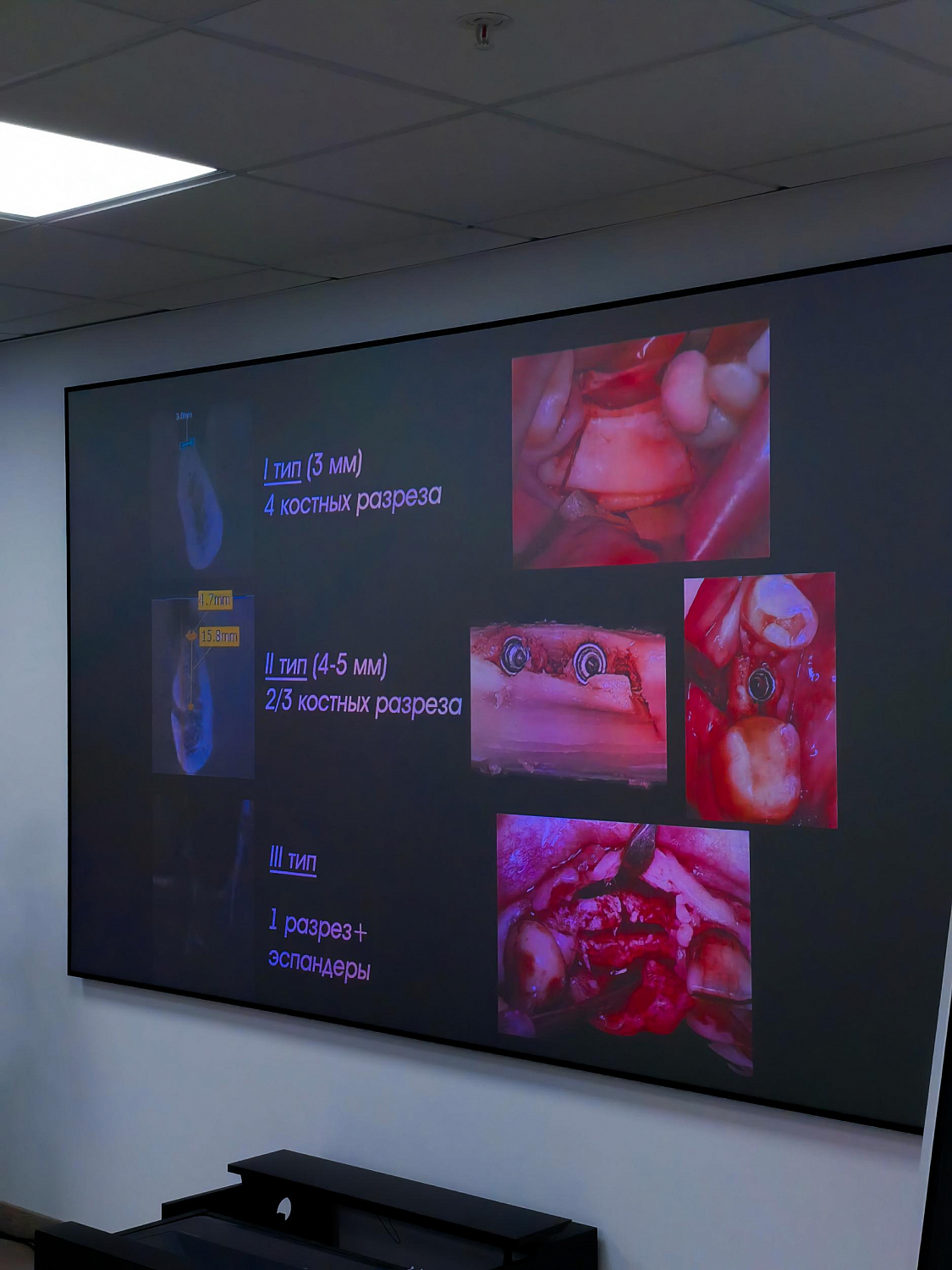 Два дня глубокой практики по костной пластике и синус-лифтингу